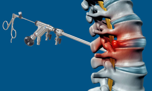 Complex and Endoscopic Cervical and Lumbar Spine Surgery in Nagpur