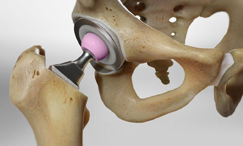 Hemi Replacement of Hip in Nagpur