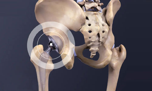 Hip Replacement in Nagpur