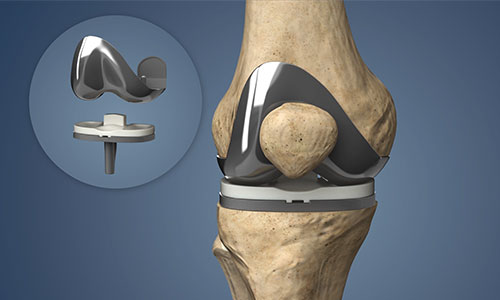 Knee Replacement in Nagpur