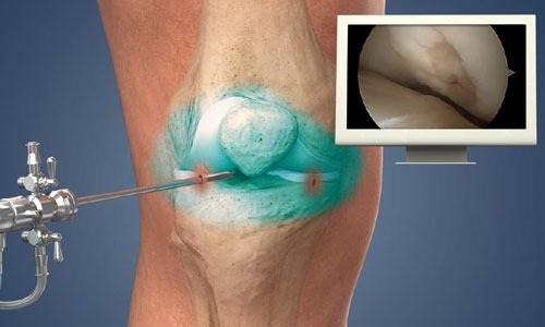 Knee Arthroscopy in Nagpur