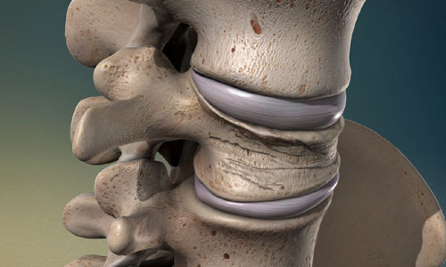 Osteoporotic Fractures Treatment in Nagpur