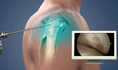 Shoulder Arthroscopy in Nagpur